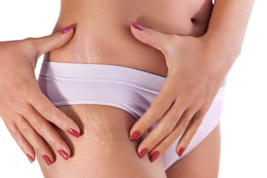 stretch marks on female hips масажни масла против стрии.
