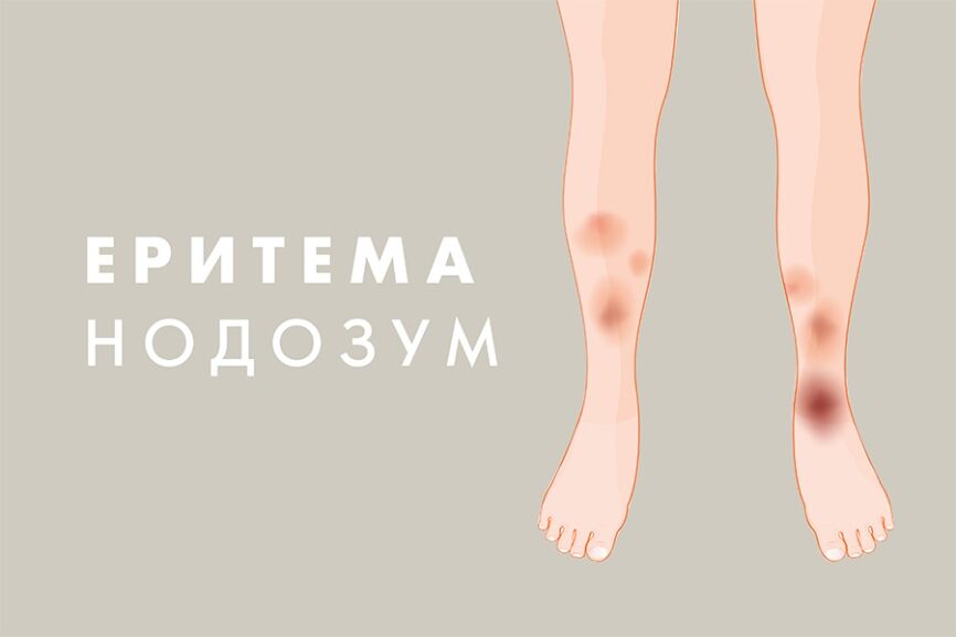 nodozna-eritema- Нодозна еритема.